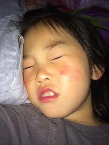 大家帮我看看我女儿脸上长的什么啊,满脸红血丝从小就有,脸颊两边一边