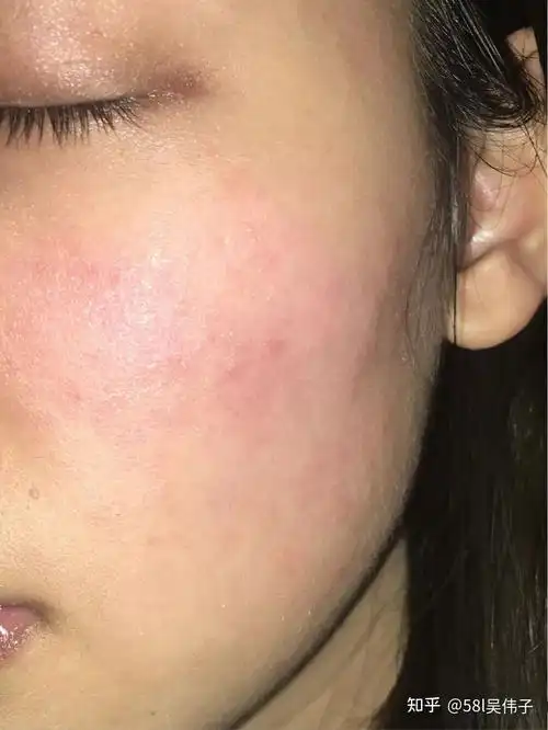 氯化锌乳膏治过敏_庆大霉素治过敏吗_皮肤过敏怎么治