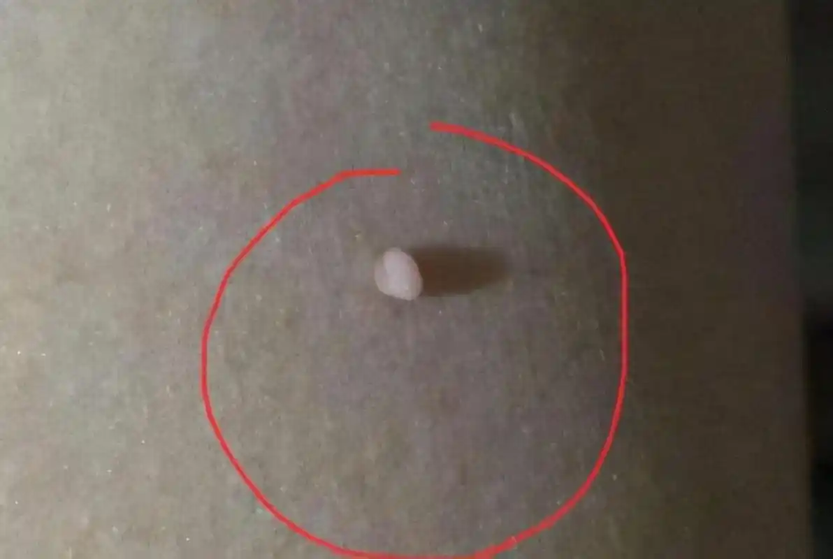 脖子和腋下的"小肉粒"是什么?能直接用手揪掉吗?看完要记牢