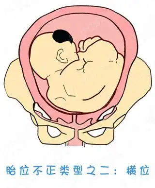 纠正胎位的正方法(图)(2)