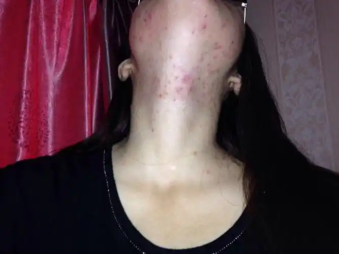 阴茎长毛囊炎的症状图片