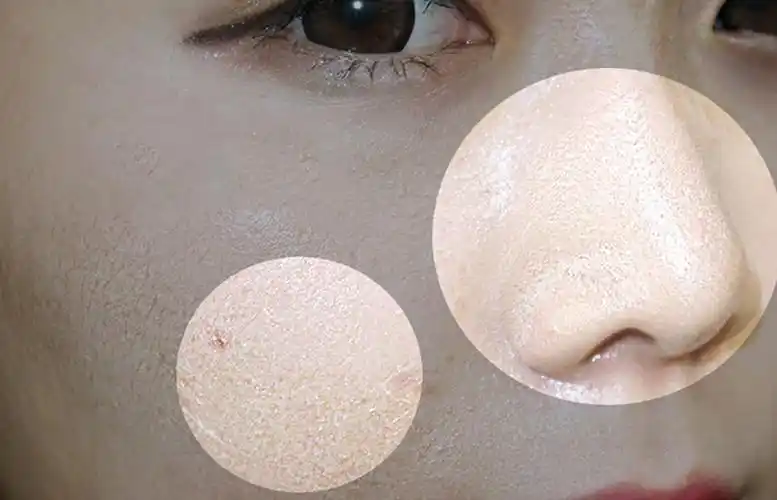 首先要区分皮肤油脂和皮肤角质的区别,去角质产品去的是你表皮的角质