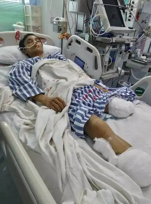 最终进行了腿部双截肢手术