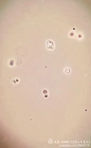 非新鲜尿中的棘形红细胞