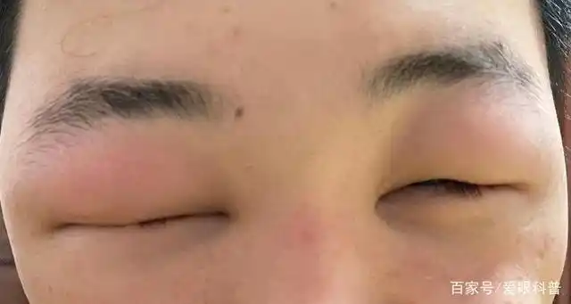 3.突然眼睑肿胀怎么办?