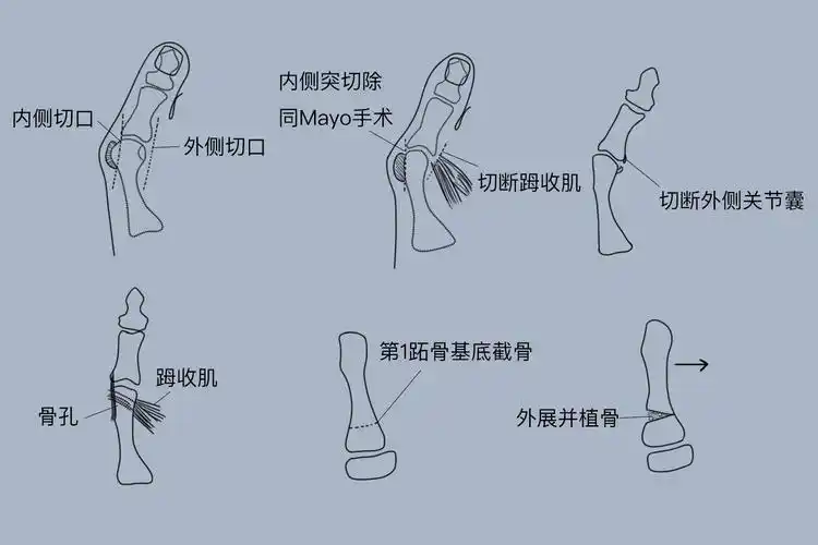 拇外翻手术过程图解_有来医生