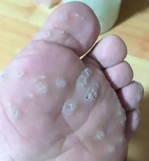 鸡眼什么样子(鸡眼你真的认识吗)(3)