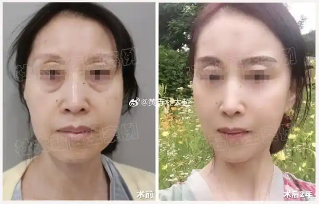 caw小切口面部提升##拉皮手术