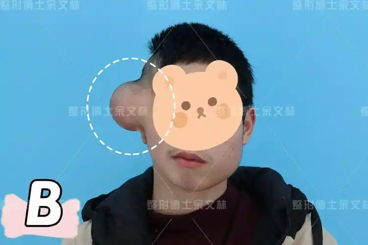 终于在寒假做完了耳再造二期手术_耳廓_扩张_耳朵