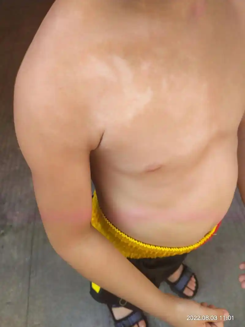 白癜风得选正规三甲医院治疗.