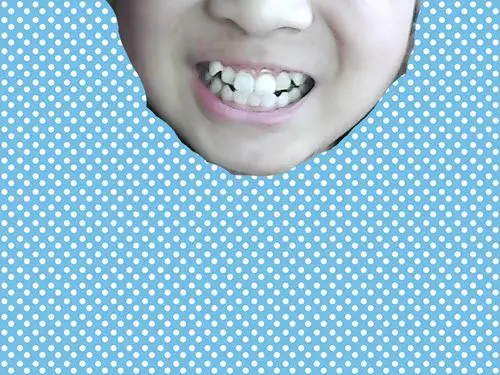 我孩子今年12周岁,女孩,她有两颗虎牙向外突出,上牙有6颗,下牙有5颗.