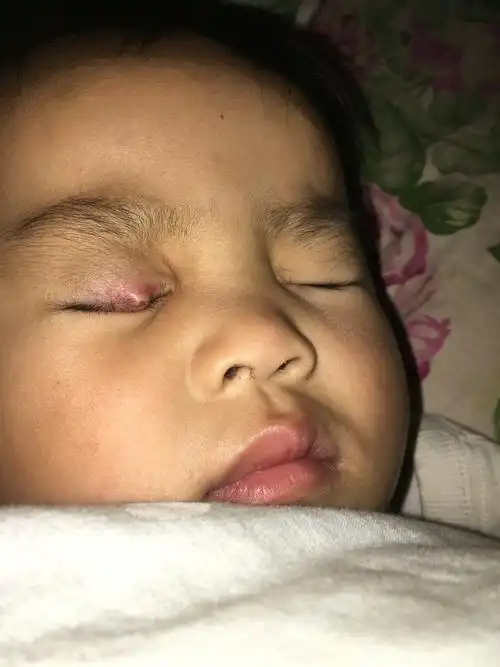 眼睛长包怎么回事 眼睛长包怎么回事不疼不痒