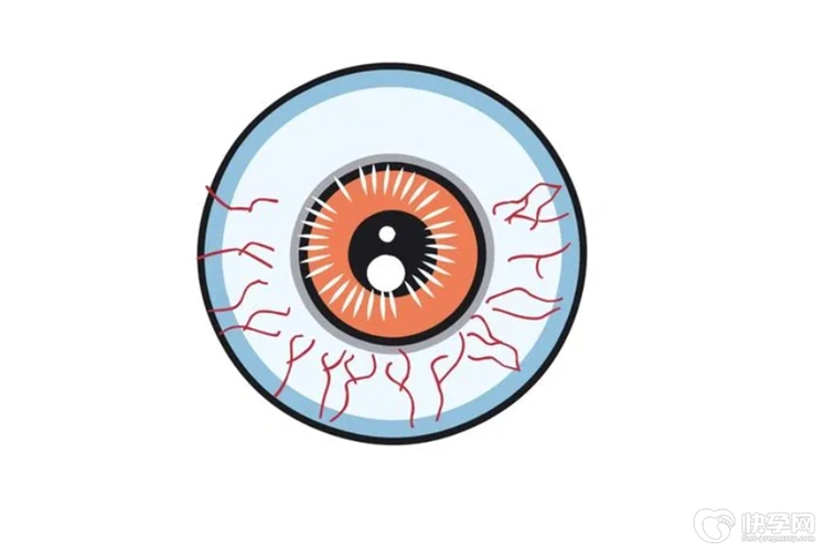 眼睛红血丝是怎么回事,眼睛有红血丝怎么消除-六个方法太管用了