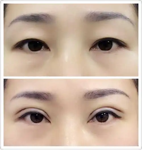 沈阳孟强做的双眼皮手术当时效果好吗?