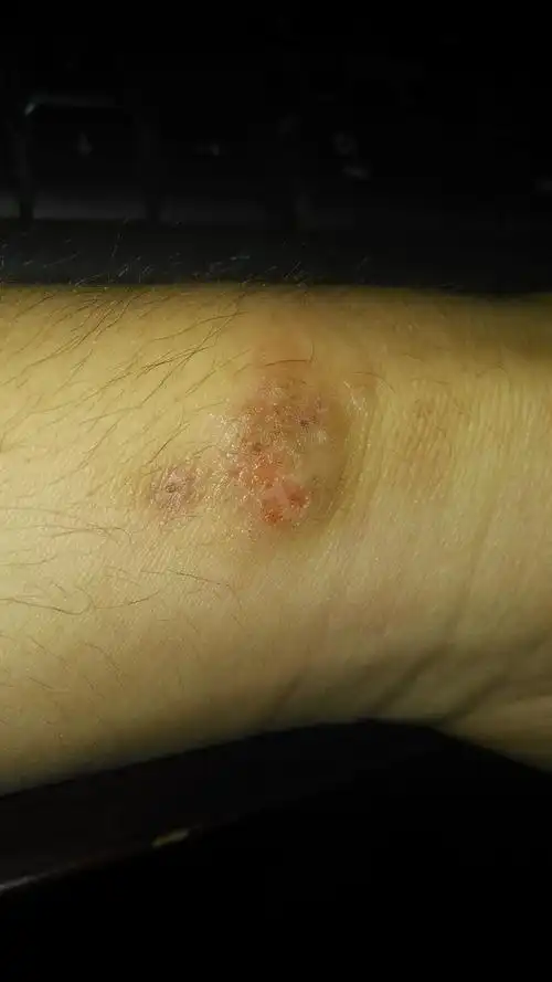 反复的皮肤溃烂