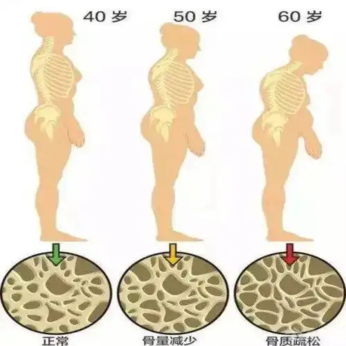 主要是由于骨形成减少,骨量下降且流失加快,骨骼中空隙增加,形成骨质