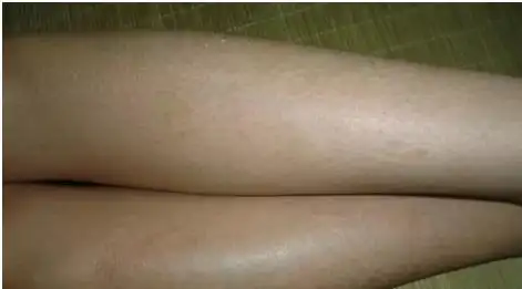 洗澡洗出鱼鳞病你还敢这样洗澡