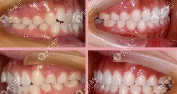 牙齿咬合发生的改变 图源www.bjqnw.com