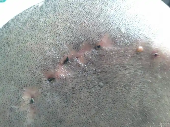 颅骨修补病人术后头皮切口线头排斥问题