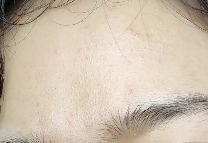 求助!干皮夏天额头出油,毛孔粗大怎么整