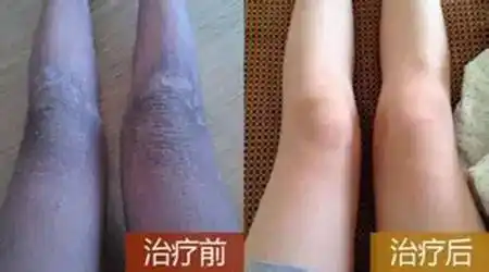牛皮癣,鱼鳞癣,白癜风,皮炎湿疹,荨麻疹,各类杂癣等皮肤病,想治好自己