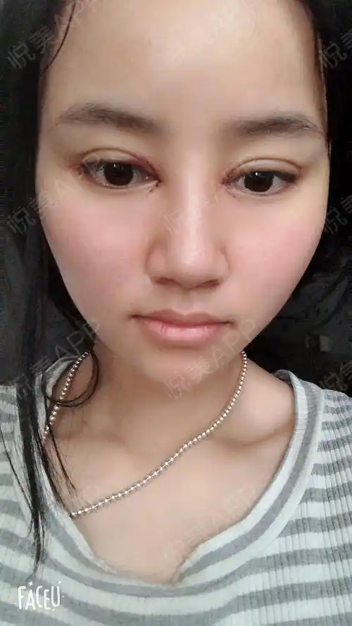 埋线双眼皮 开内眼角 术后1天