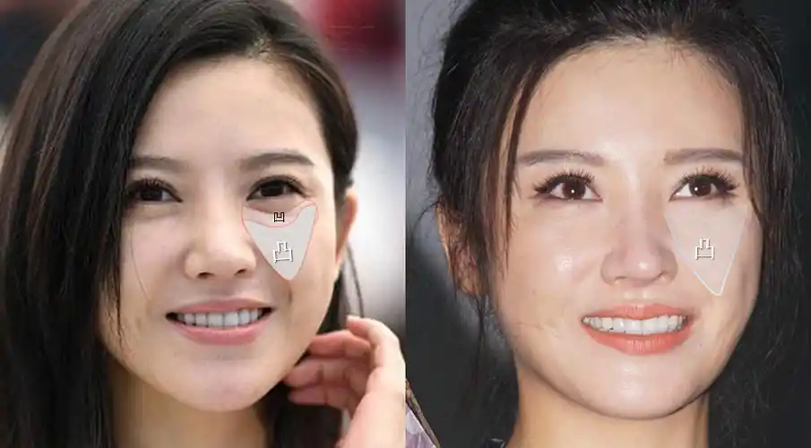 为什么女明星,总是整成蔡明阿姨同款脸,原因在这.