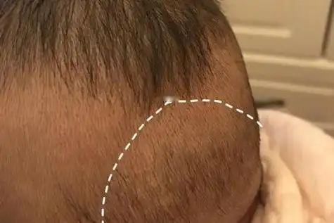 佝偻病宝宝后脑勺图