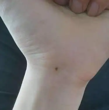 宝宝右手手背中间有颗痣(手上有这3颗痣的宝宝长大后都能前程似锦)(3)