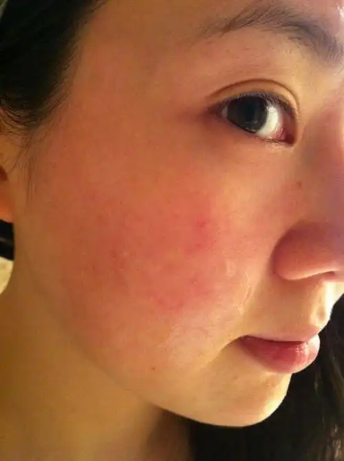 脸部皮肤过敏 (症状)