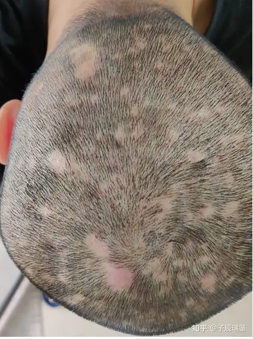 毛囊炎治疗之路(非药托)