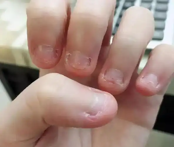 据不完全统计,有30%多的儿童抑郁症患者,都有过类似咬指甲的行为.