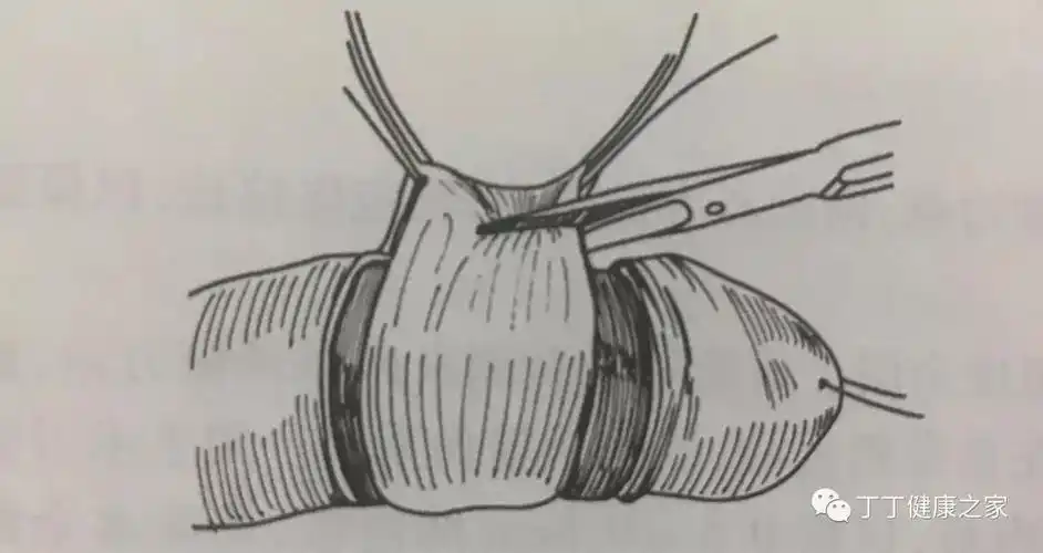 包皮环切手术的演变之——切割缝合器法