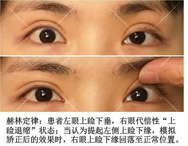 上睑下垂的诊断,治疗和护理_上睑下垂_发病原因_检查_治疗方式_日常