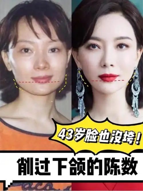陈数做了下颌角为何脸没垮 对比了下面部的变化,削下颌骨应该
