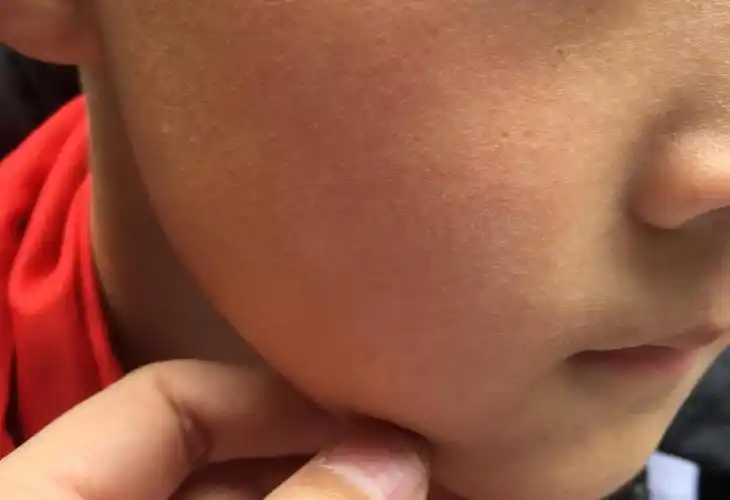 儿童戴口罩后出现面部皮疹瘙痒是否考虑接触性皮炎引起