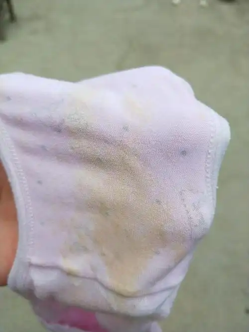 其他回答 孕期分泌物多是正常的 保持阴道干净勤换内裤 一天换一次