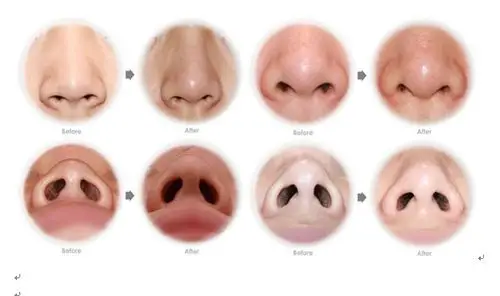 鼻翼下垂或肥厚案例