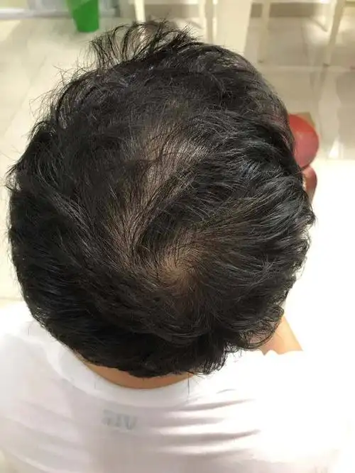 男人掉头发是什么引起的?