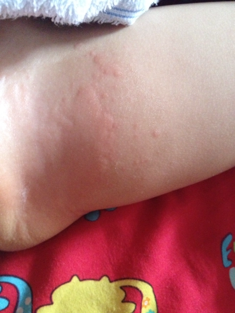 刚才发现宝贝大腿内侧出现好大一片这,宝贝说好痒,头一次出现这情况