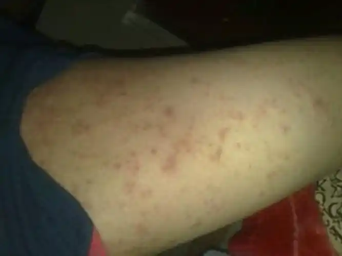 孕妇疥疮初期腹部皮肤症状图片