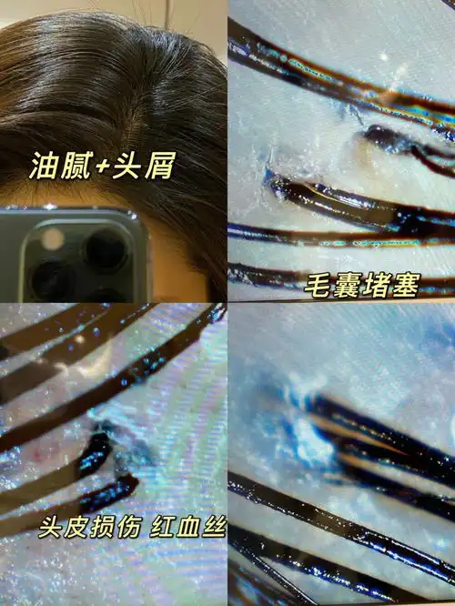 头皮护理攻略头皮毛囊的深层清洁养护