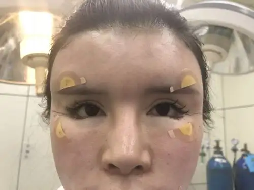 脂肪填充要吃消炎药吗全脸自体的脂肪填充多久消肿