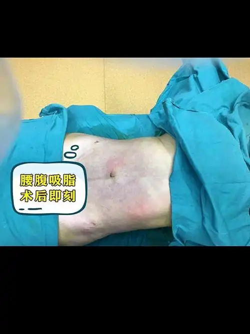 91吸完脂皮肤会下垂71这是个伪命题75大家都知道,吸脂_圈子