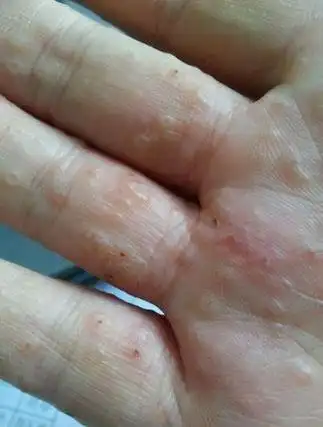 为什么天气热会引起湿疹(为什么天气热会引起湿疹加重)