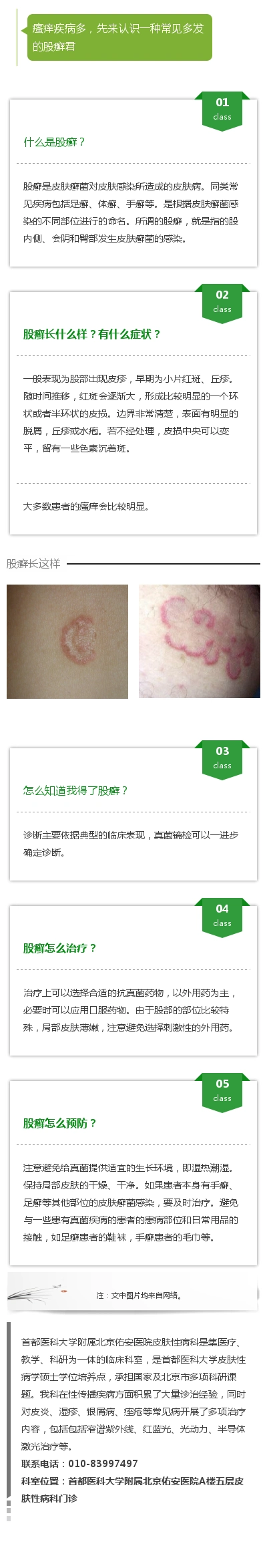 关于股癣的一些问题_股癣_症状_预防_治疗方法_症状表现_如何预防