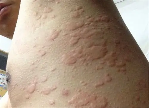 寒冷性荨麻疹手背皮肤病图片