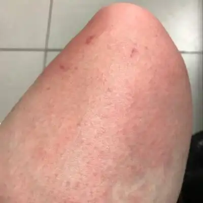 挠了,手没挠还是有红色小点点,医生说是孕期会有的,这是不是妊辰痒疹?