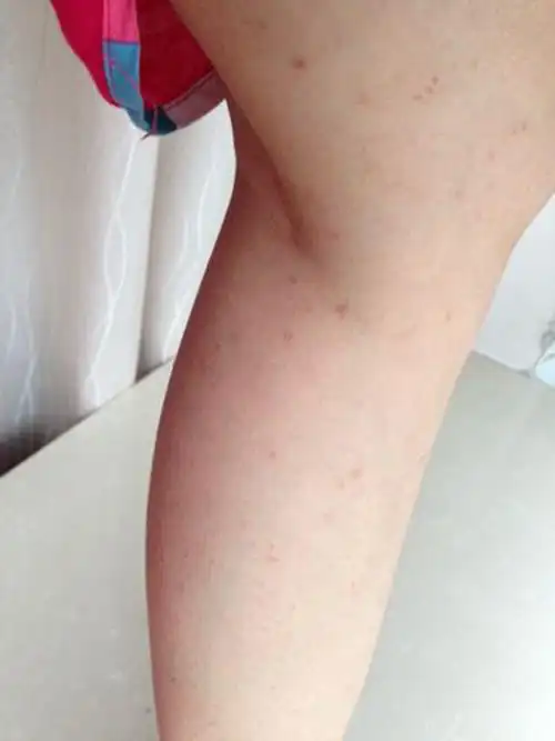 孩子螨虫过敏症状图片大全