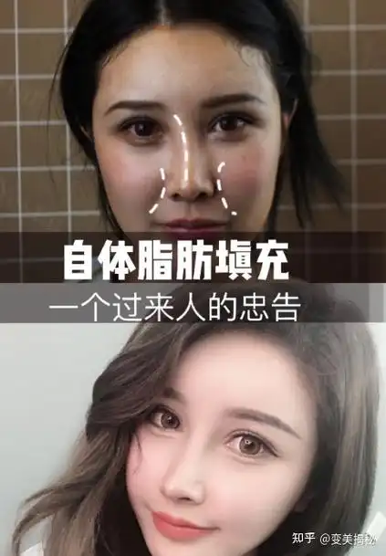 面部多少有点凹陷的当时在手机上看到这家医院脂肪填充案例,当时觉得